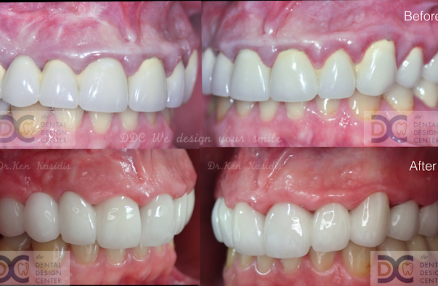Correction of poor bridgework and severe gingival inflammation
