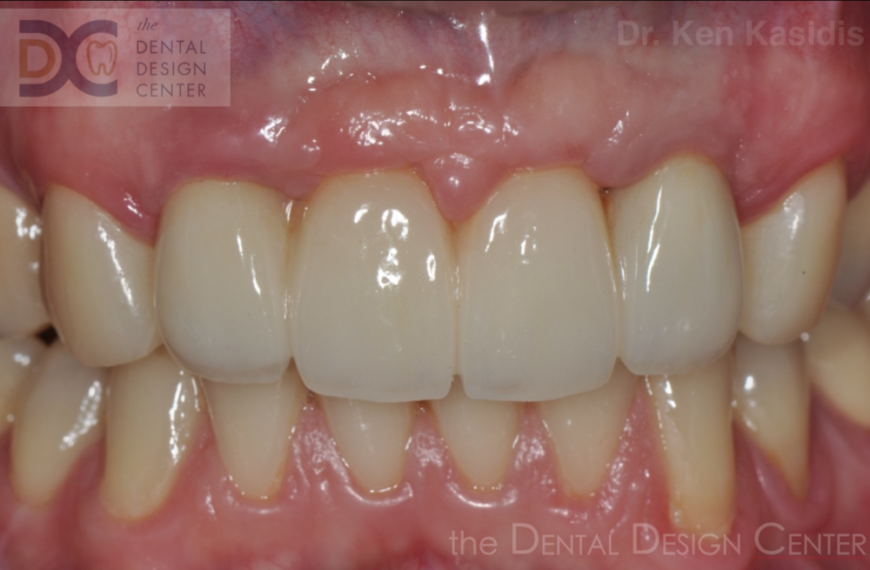 Correction of anterior protrusion with dental implants