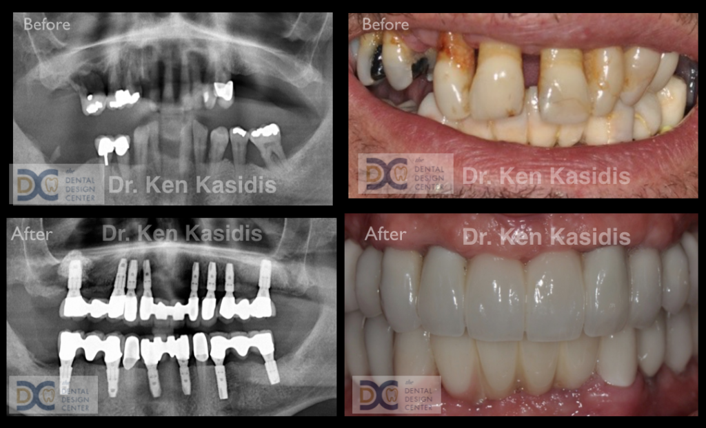 Full mouth dental implant pattaya