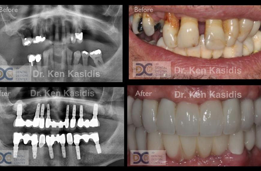 Treatment Menu for Full Arched Fixed Dental Implant Restorations