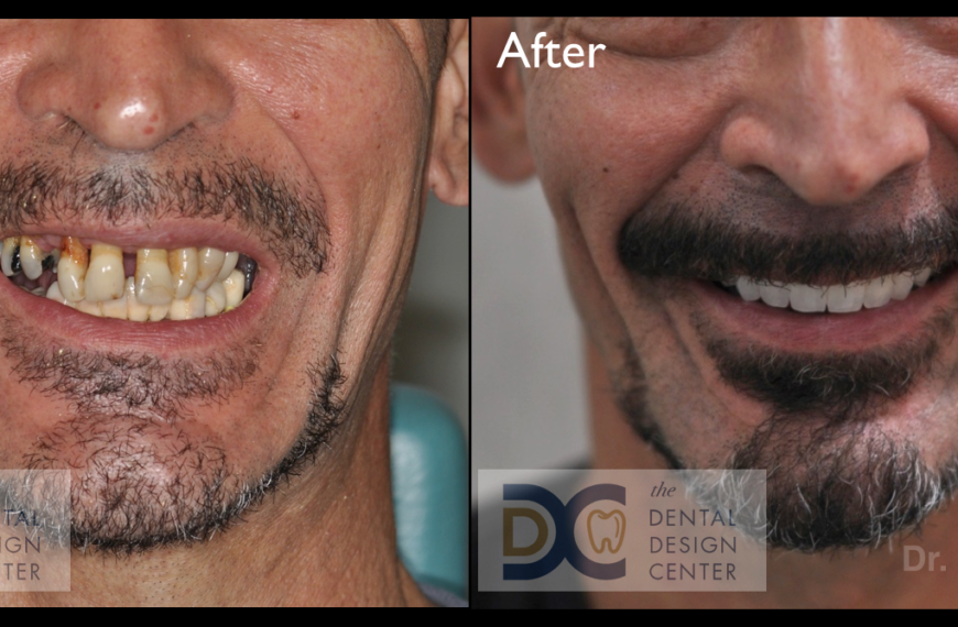 Treatment planning to achieve the best aesthetic result in full-arch implant prostheses.