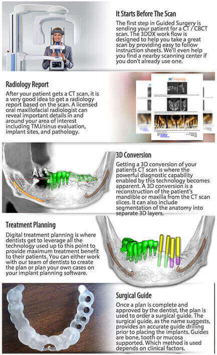 3d guided implant sugery