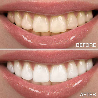 before after teeth whitening