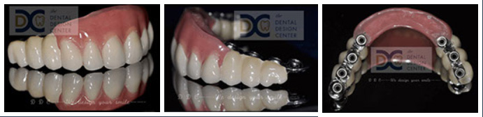 dental implant01 1