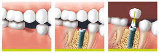 implant solution