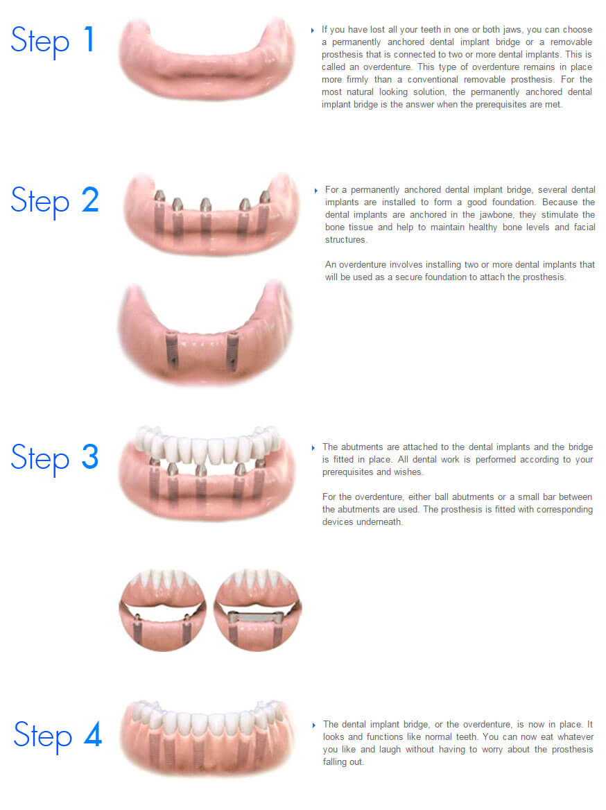 implantprocedure3