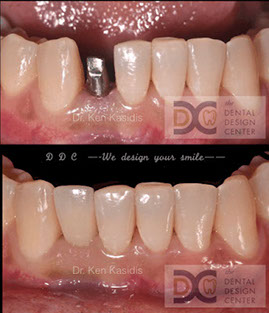 lower ant implant ddc
