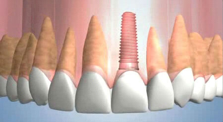 What are Dental Implants