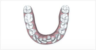 overly crowded teeth