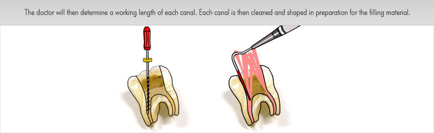 root canal treatment img2