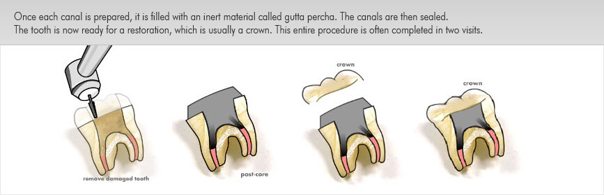 root canal treatment img3