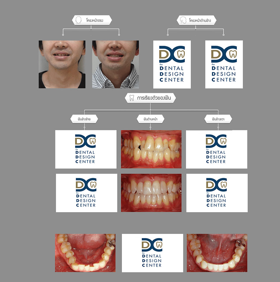 invisalign1