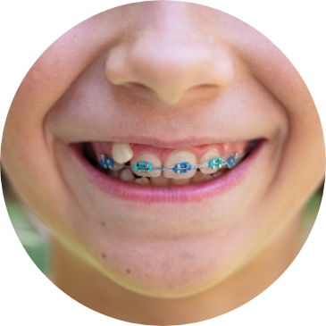 child with dental braces 2021 10 04 22 18 25 utc