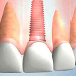 Dental Implant in Pattaya