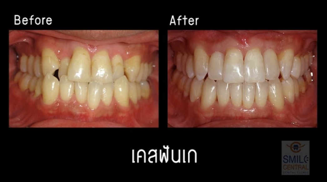 จัดฟันใส invisalign เคสฟันซ้อนเก เด็นทัลดีไซน์เซ็นเตอร์ พัทยา Dental