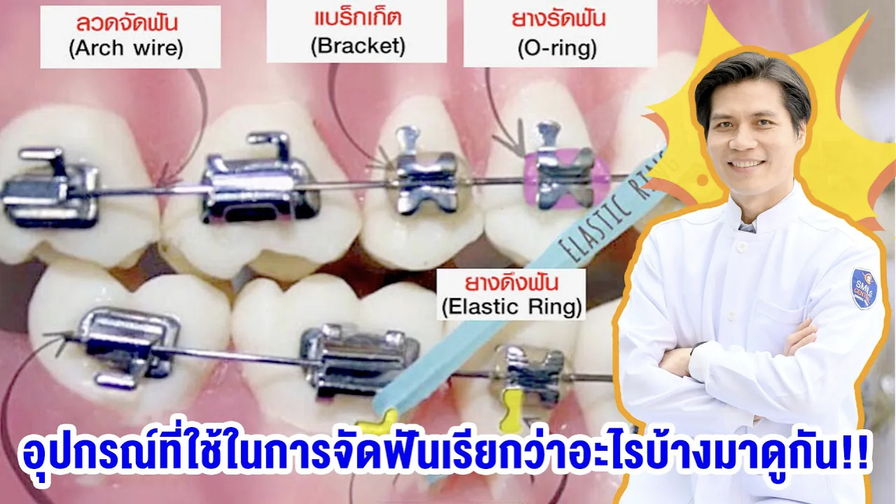 อุปกรณ์ที่ใช้ในการจัดฟันเรียกว่าอะไรบ้างมาดูกัน!! - Dental Design Pattaya