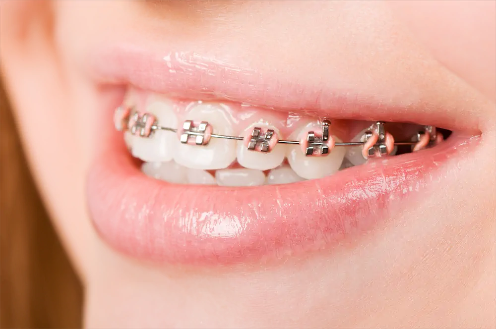 02 different types of braces for teeth
