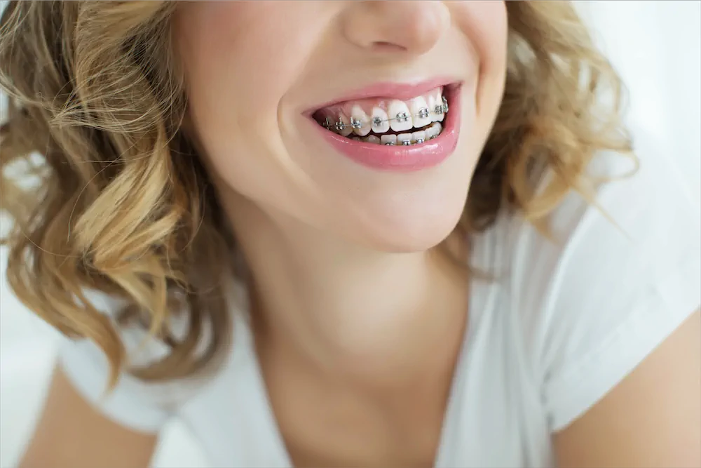 03 different types of braces for teeth