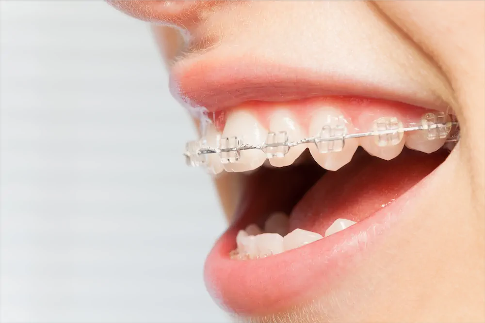 06 different types of braces for teeth
