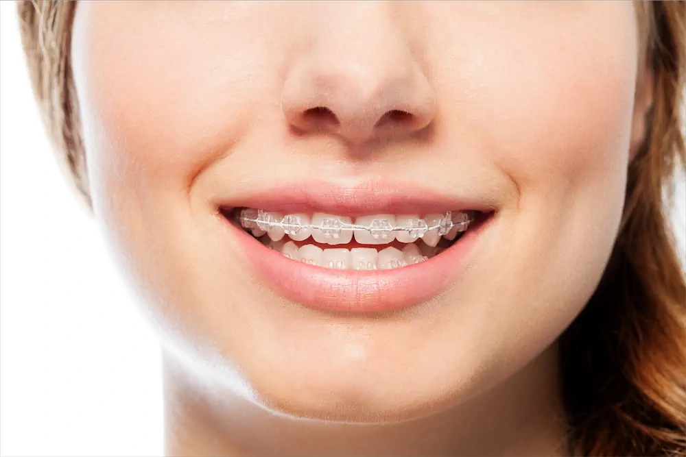 07 different types of braces for teeth