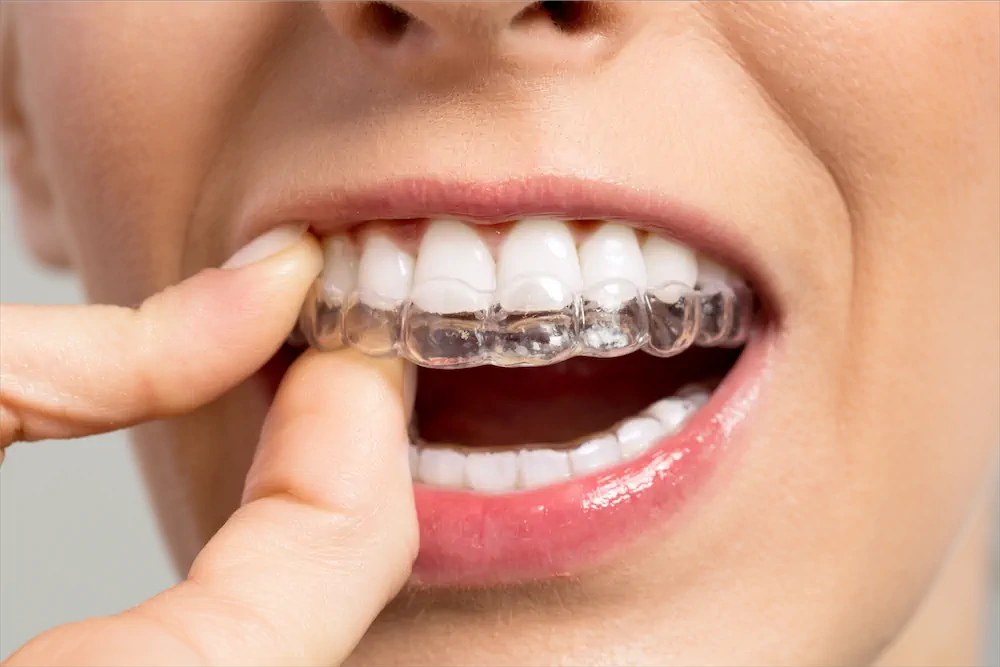 08 different types of braces for teeth