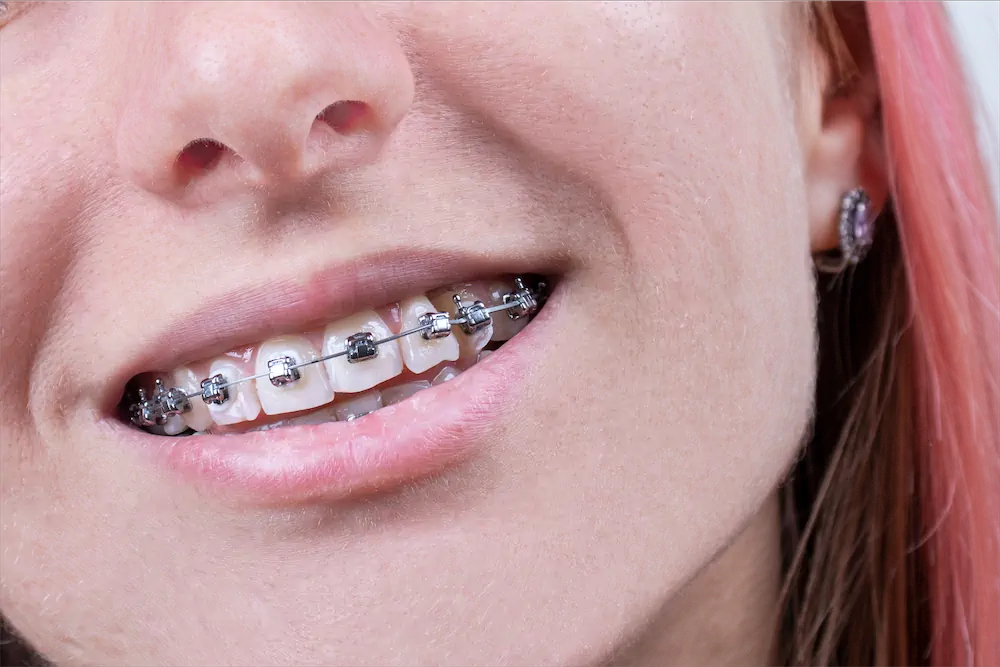 Cover different types of braces for teeth