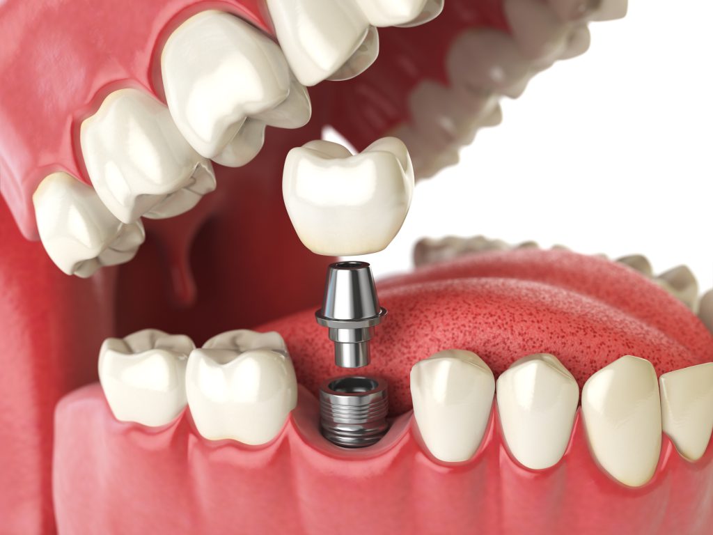 04 what is the difference between dentures and implants