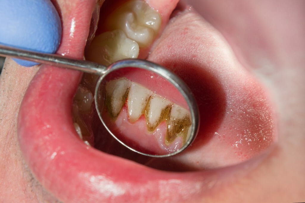 01 how to prevent dental plaque buildup