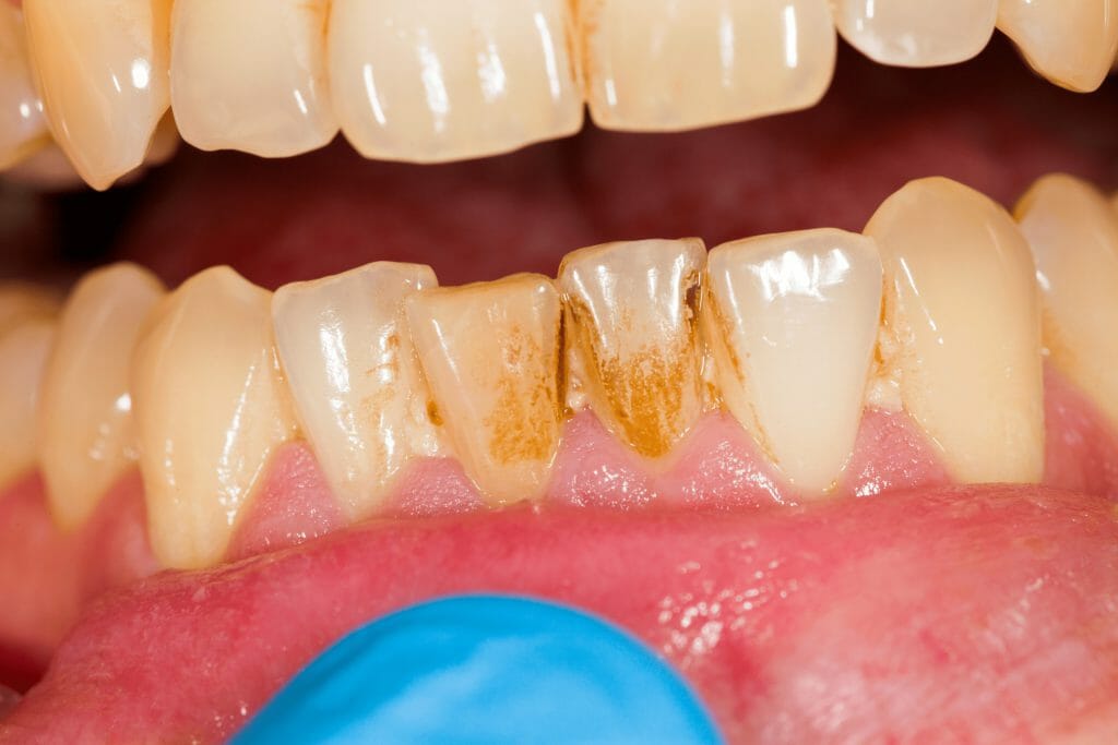 02 how to prevent dental plaque buildup 2 1