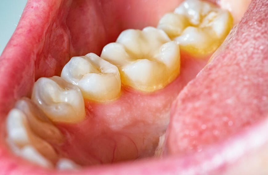 Simple ways to prevent tartar buildup and reduce the amount of tartar in the mouth