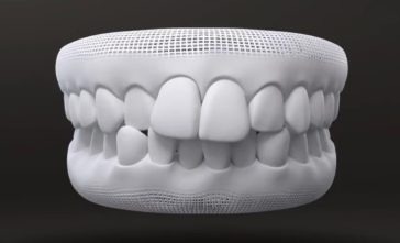 Misaligned teeth - Invisalign Case