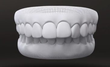 Protruding Tooth - Invisalign Case