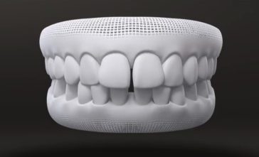 Spaced teeth - Invisalign Case