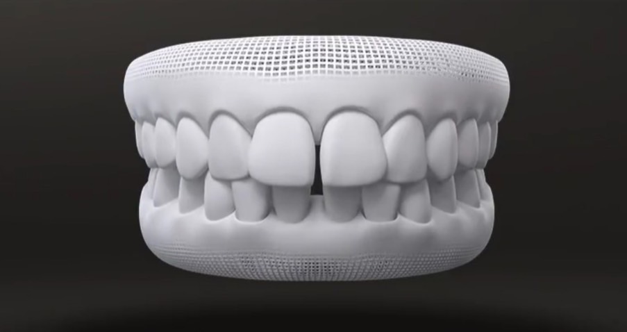 Spaced teeth - Invisalign Case