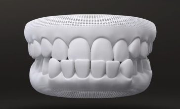 Under Bite - Invisalign Case