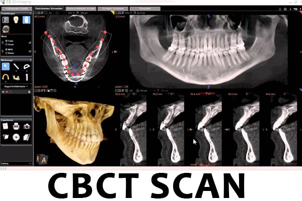 CBCT SCAN