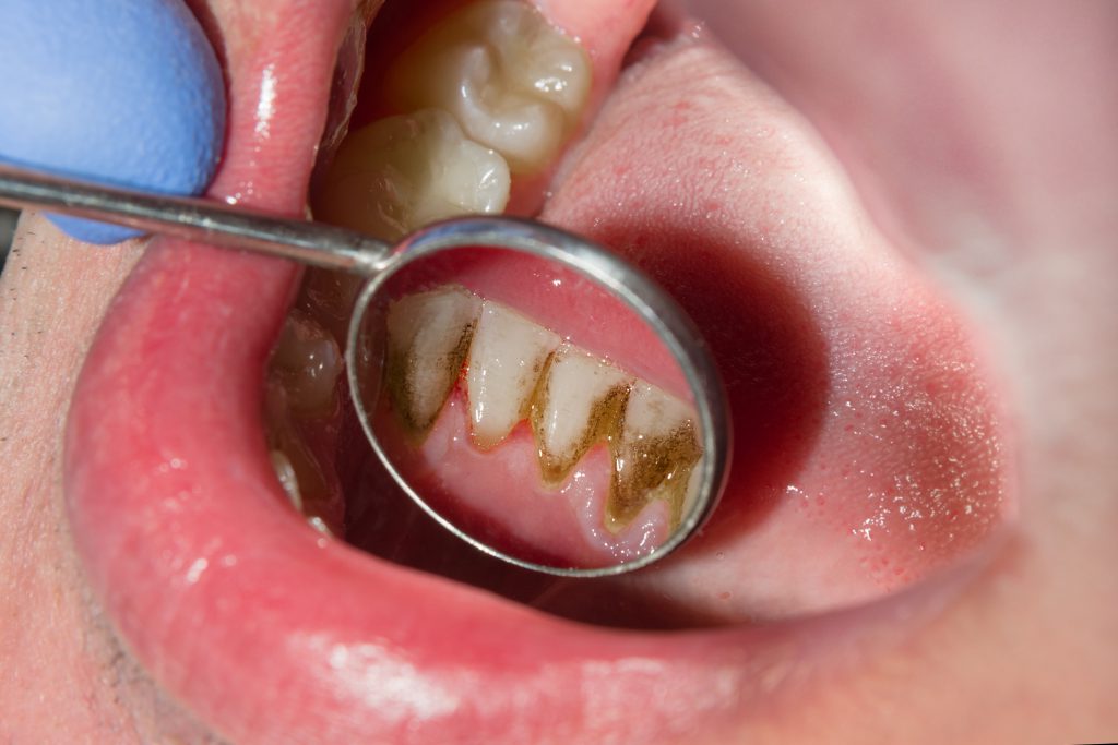 03 causes of tooth decay