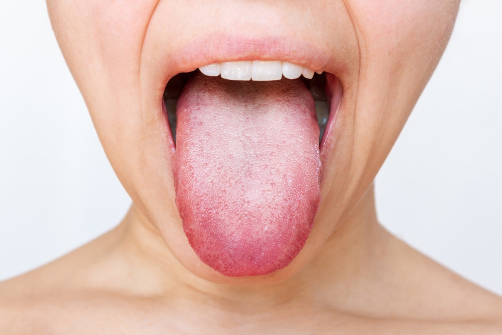 Cover natural treatments for white tongue