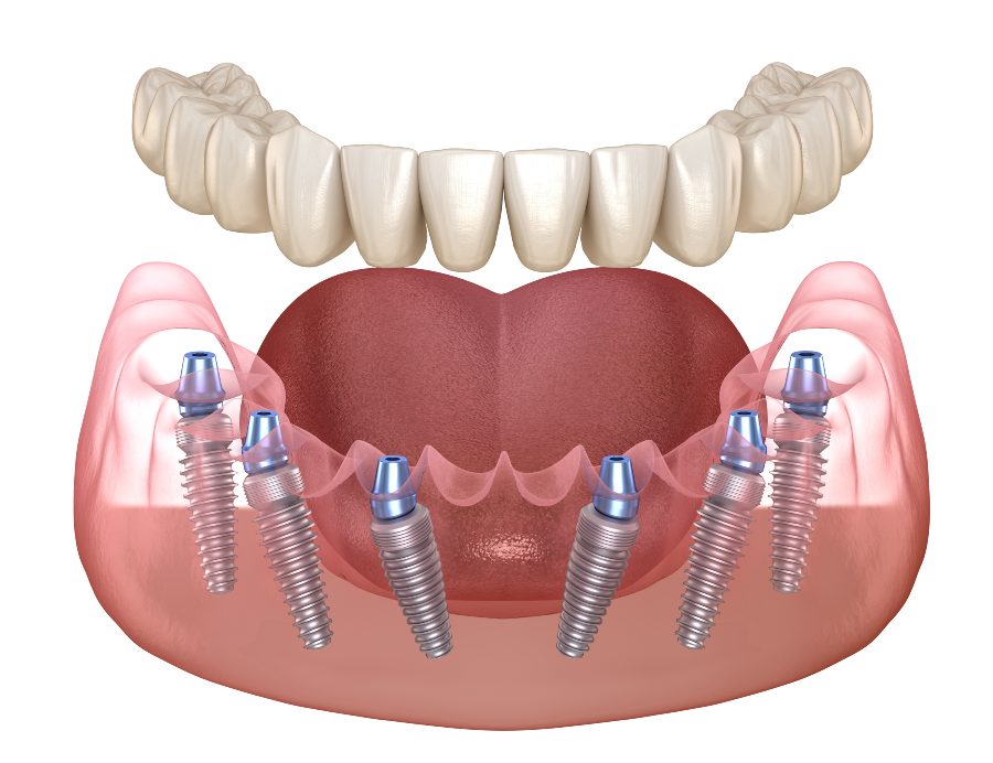 3 on 6 Dental Implants in Turkey