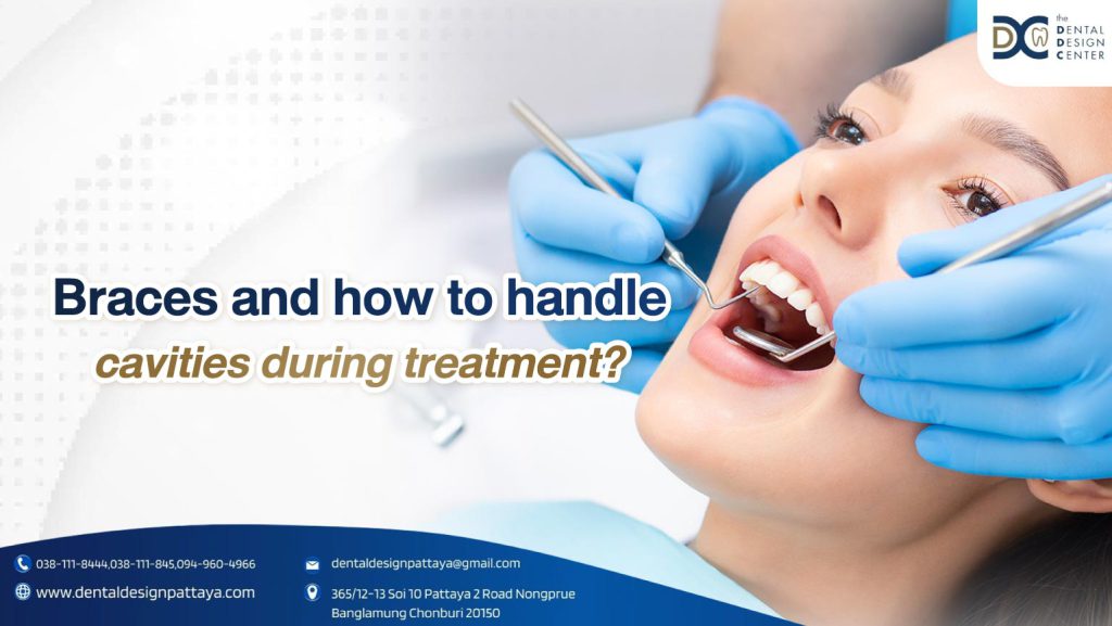 Braces and how to handle cavities during treatment 1