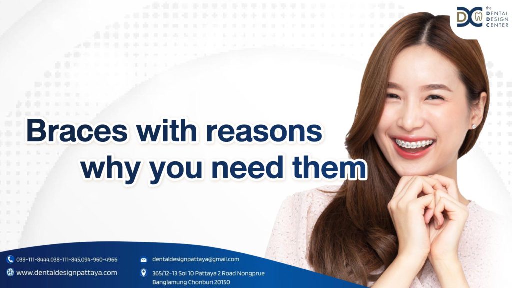 Braces with reasons why you need them