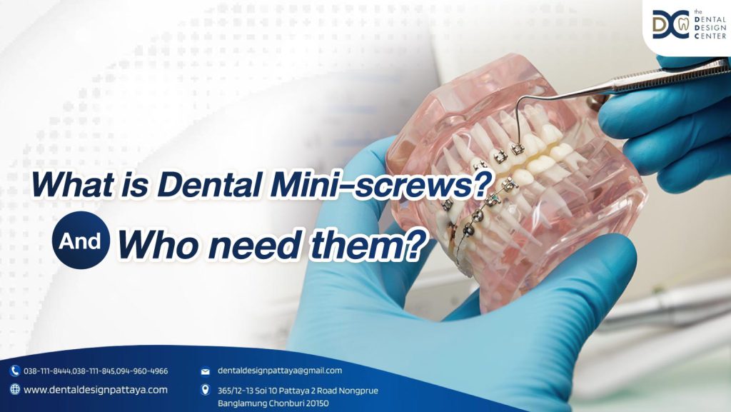 What is dental mini-screws And who need them