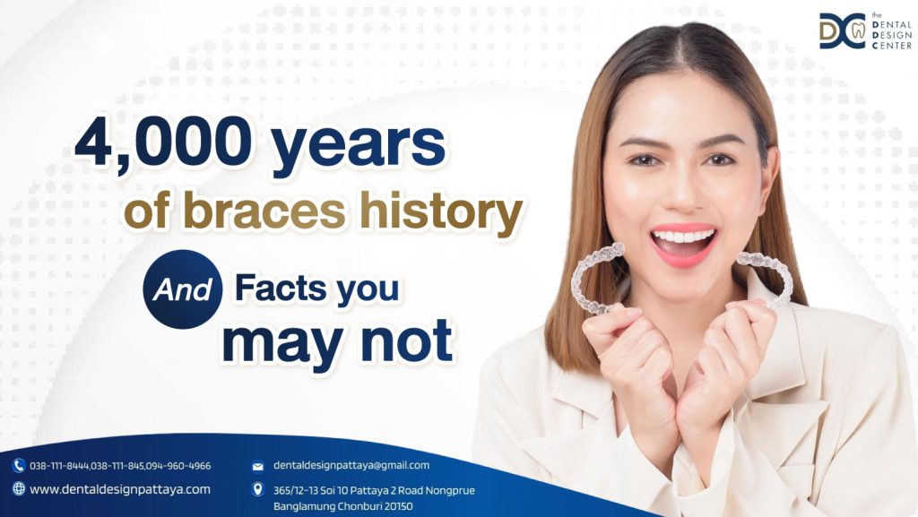 4,000 years of braces history and facts you may not know