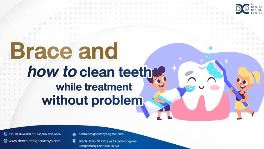 Brace and how to clean teeth while treatment without problem