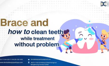 Brace and how to clean teeth while treatment without problem