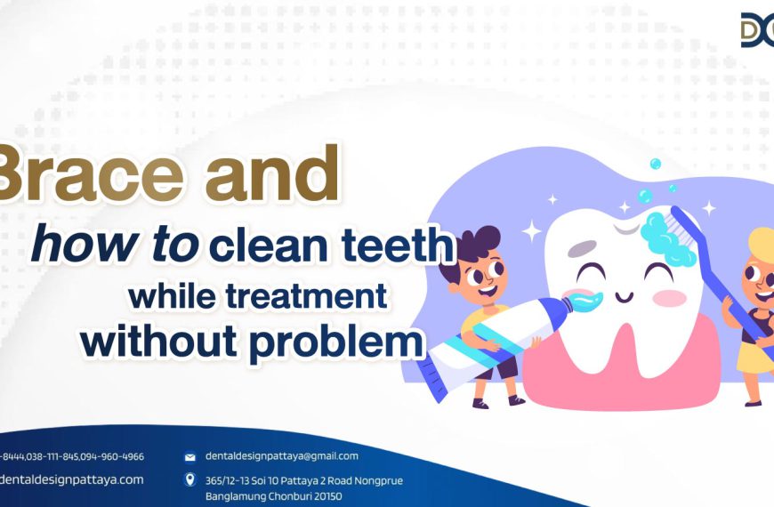 Brace and how to clean teeth while treatment without problem