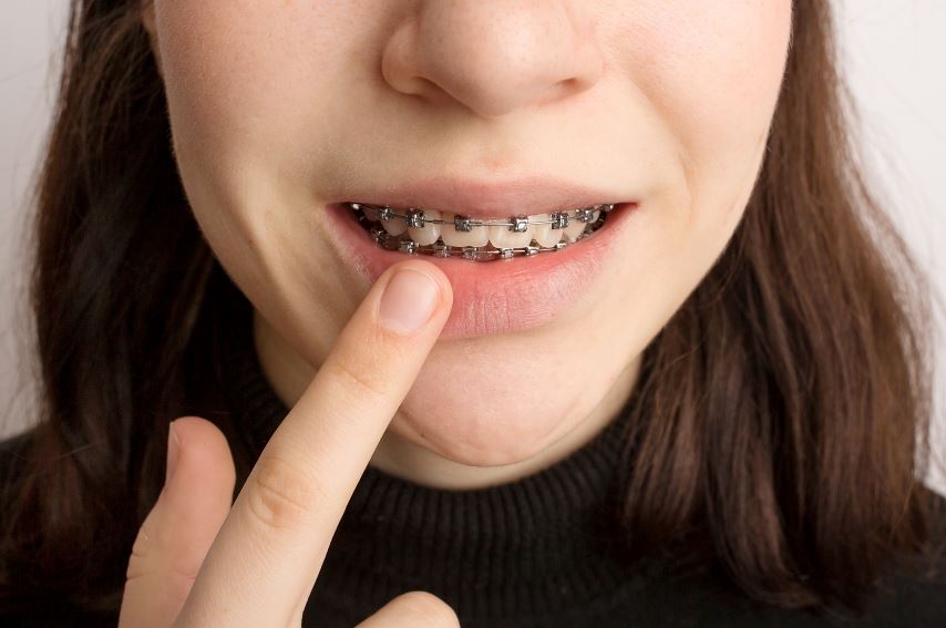 Common Problems During Braces