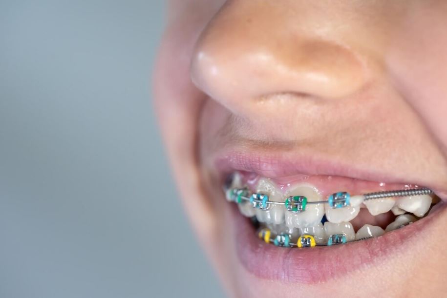 Current Braces Methods