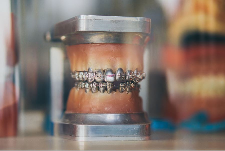 The History of Braces