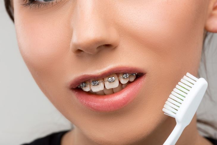 Tips for Dental Care While Wearing Braces